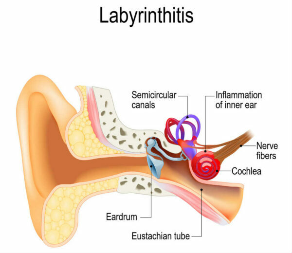 التهابات الأذن الداخلية