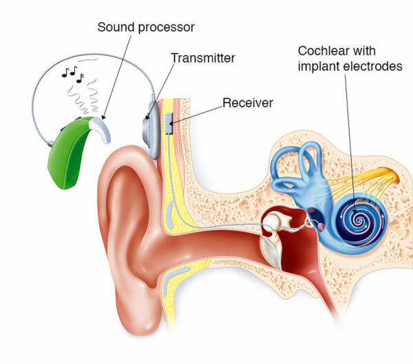 زراعة قوقعة الأذن