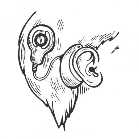 عملية زراعة قوقعة الأذن