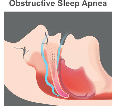متلازمة الإختناق أثناء النوم